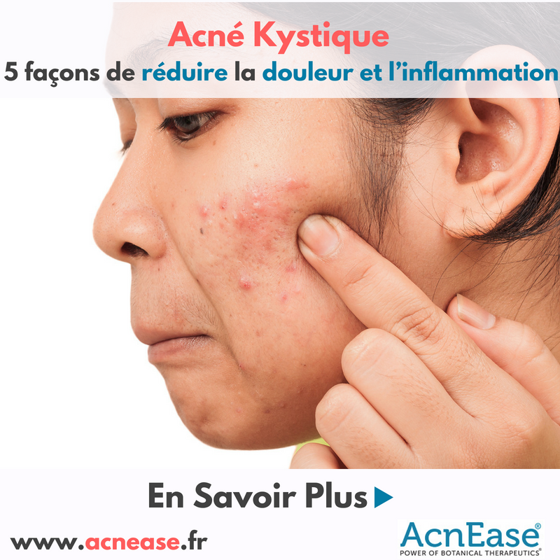5 façons de réduire la douleur et l’inflammation de votre acné kystique