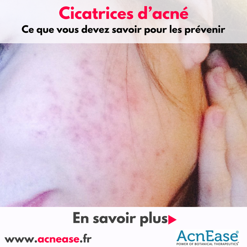 Ce que vous devez savoir sur la prévention des cicatrices d’acné