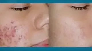 AcnEase - La Promesse d'une Peau Nette - Traitement naturel contre l'acné 