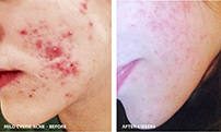 Mild Cystic acne  - before - after 4 weeks