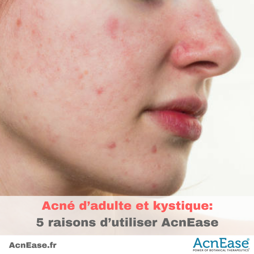 Acné d’adulte et kystique: 5 raisons d’utiliser AcnEase