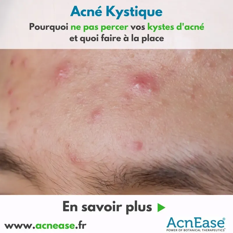 Pourquoi ne pas percer vos kystes d’acné et ce qu'il faut faire à la place