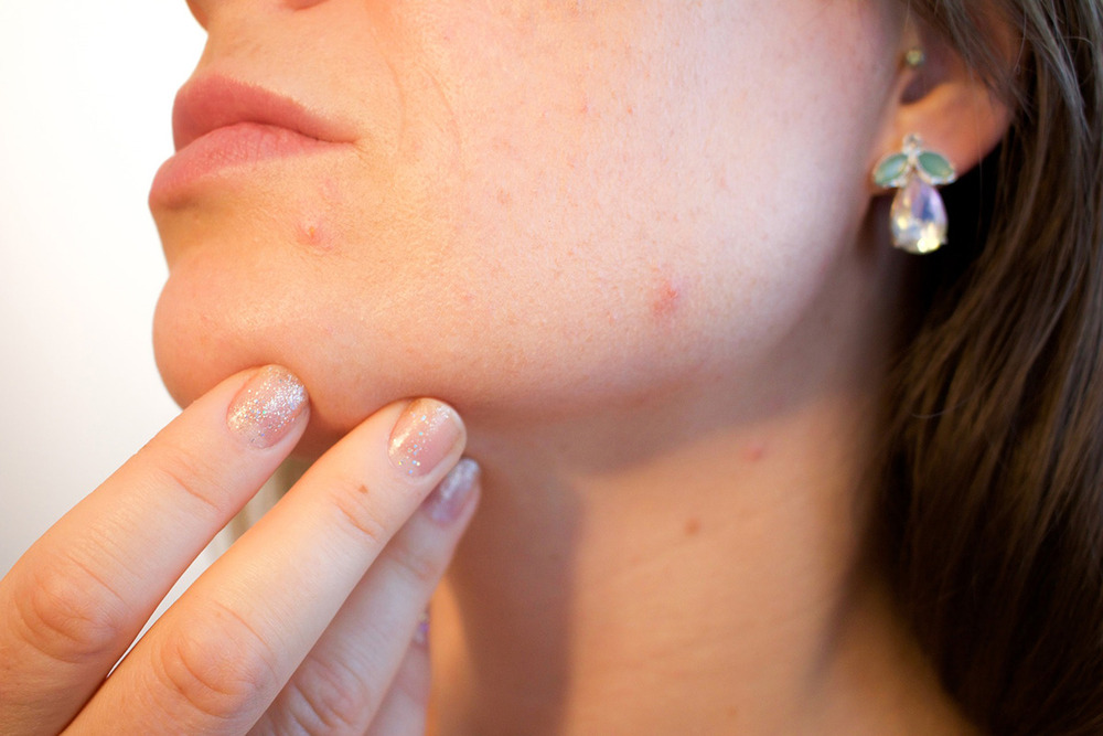 L’acné : les gestes à adopter et à éviter